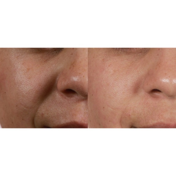 Silk’n Revit Prestige Microdermabrasion - Picture 15 of 16